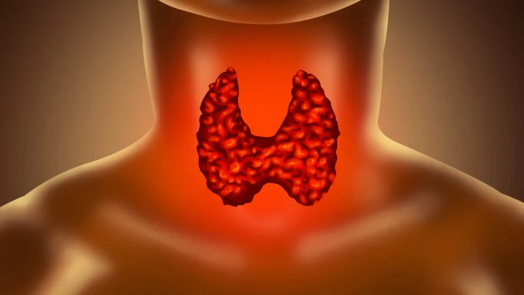 Cuello con tiroides inflamada de color rojo