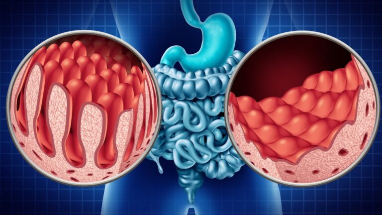 dibujo de un intestino. Sensibilidad al gluten no celiaca